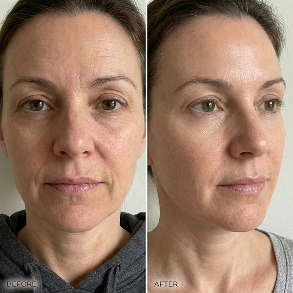 Rimpels en veroudering